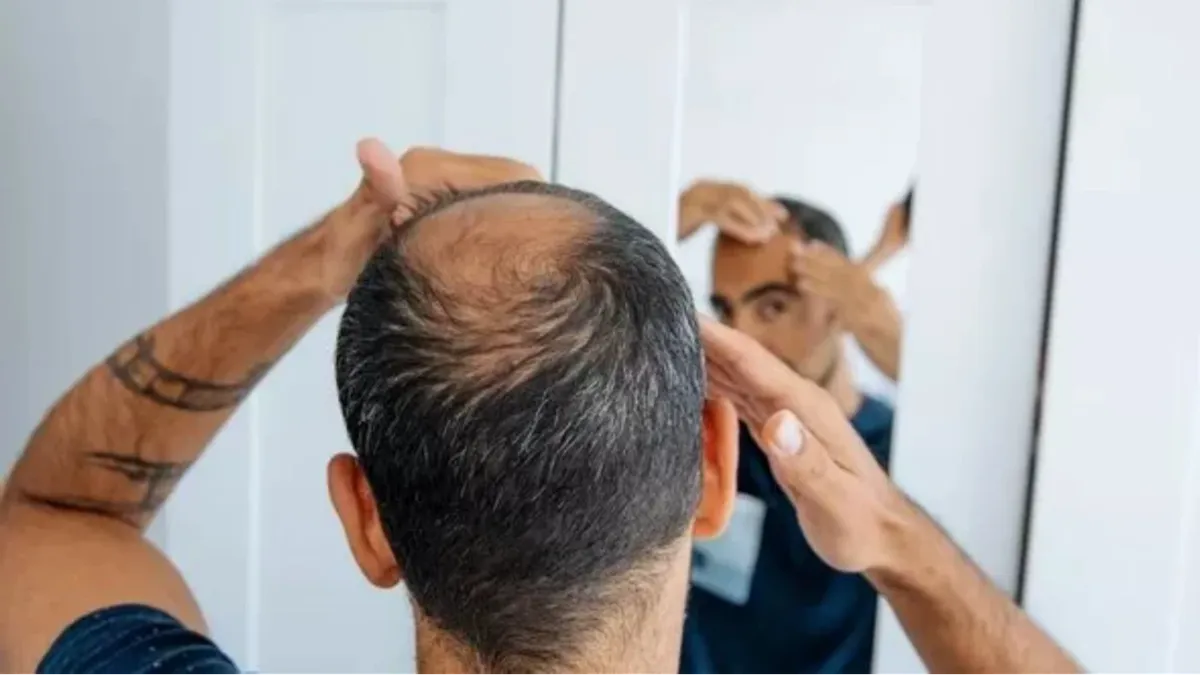 6,5 миллиона мужчин по всей Великобритании в настоящее время испытывают симптомы выпадения волос (Изображение: GETTY)
