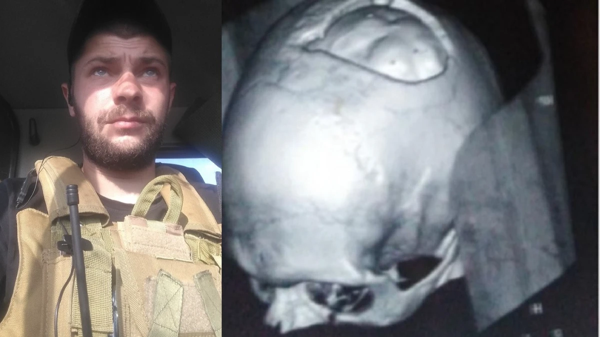 «Частично нет черепа» В Новосибирске серьезно травмированный участник СВО записал видеообращение к Травникову – сибиряк не может «добиться» выплат на лечение
