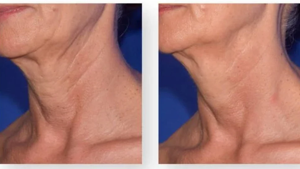 Косметическую процедуру также можно использовать на лице и шее для борьбы с морщинами. Изображение: ONE Aesthetic Studio