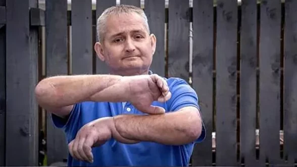 В Шотландии впервые в мире провели трансплантацию двух рук кровельщику с редким аутоиммунным заболеванием 
