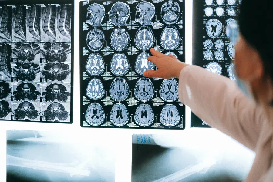 Учёные исследуют факторы риска внезапной смерти при эпилепсии