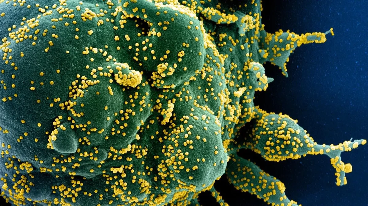 Цветная сканирующая электронная микрофотография апоптотической клетки (зеленая), сильно инфицированной вирусными частицами SARS-COV-2 (желтая), выделенной из образца пациента. Фото: Мedicalxpress.com