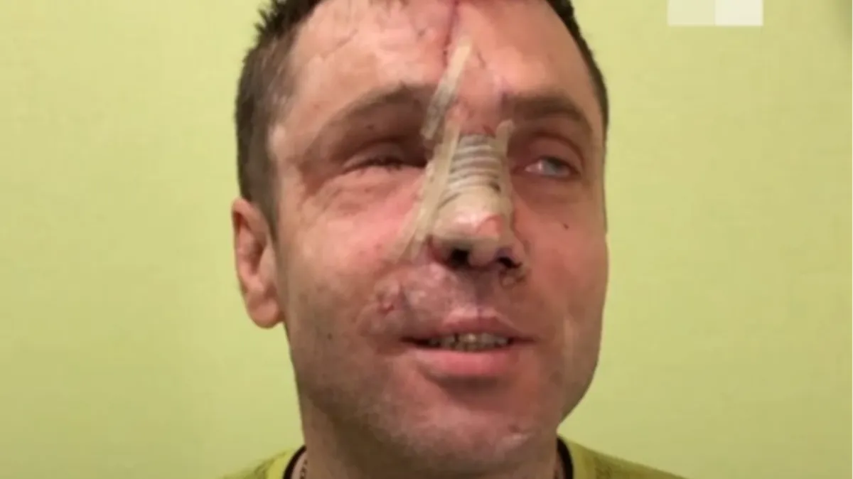 Александр Филяев спустя 9 лет от травмы может нормально дышать. Фото: кадр из видео Владислав Шитюк / Городские порталы