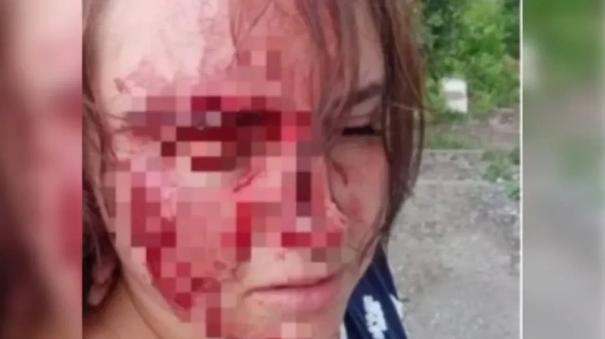 У Александры сотрясение мозга, рваные раны на лице, которые пришлось зашивать. Фото: ЧП Новосибирск / vk.com