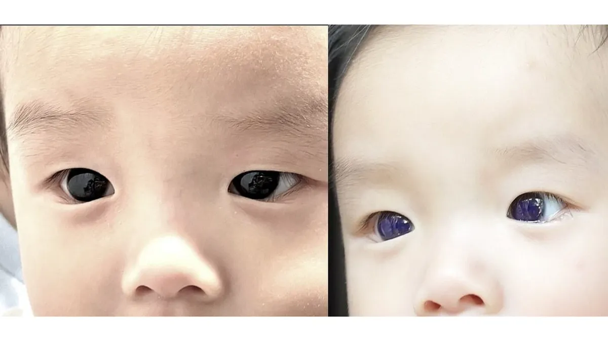 Всего через 18 часов после первой дозы мать мальчика заметила, что его глаза стали ярко-голубыми. Фото: Chulabhorn Royal Academy