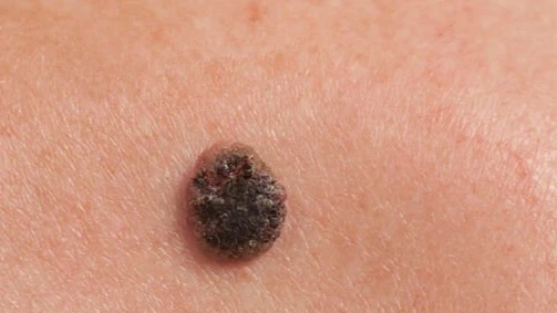 Симптомы рака кожи: как выглядит рак кожи? 10 признаков, чтобы проверить
