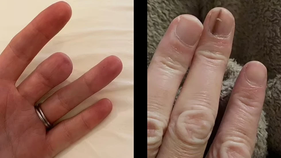 Слабая коричневая полоска на ногте 40-летней британки оказалась раком, который дважды возник на одном пальце - его ампутировали 

