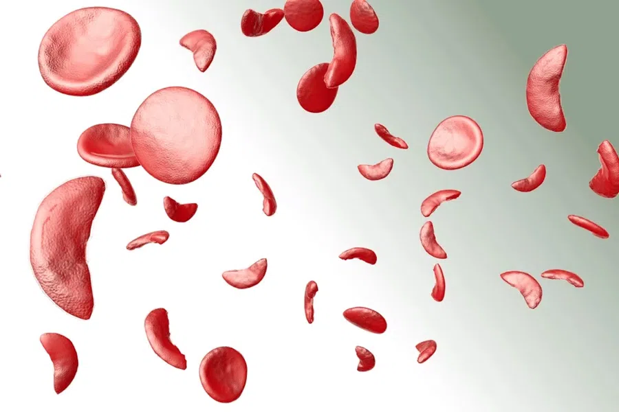 Серповидноклеточная анемия: что это такое, кто болеет, как лечить и каковы симптомы?