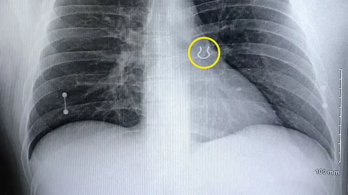 Врачи нашли кольцо в носу 35-летнего мужчины, потерянное 5 лет назад, застрявшее  в его легких после того, как взяли его на рентген из-за опасений пневмонии  