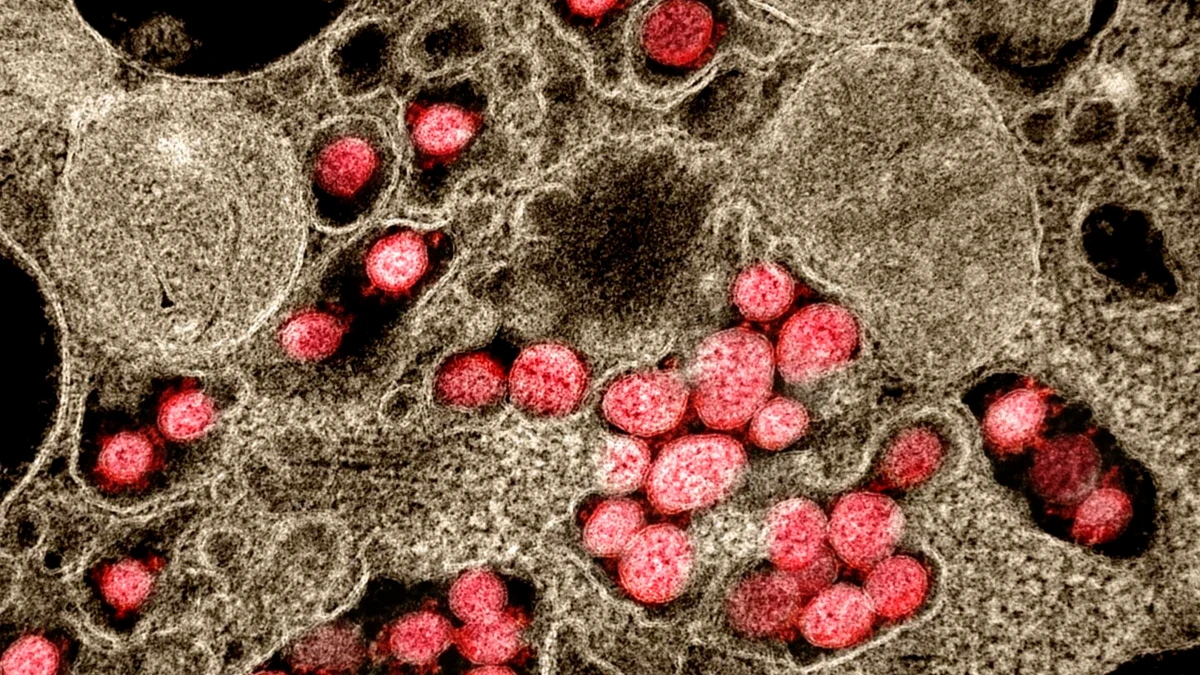 Трансмиссионная электронная микрофотография частиц вируса SARS-CoV-2, выделенных от пациента. Фото: Мedicalxpress.com