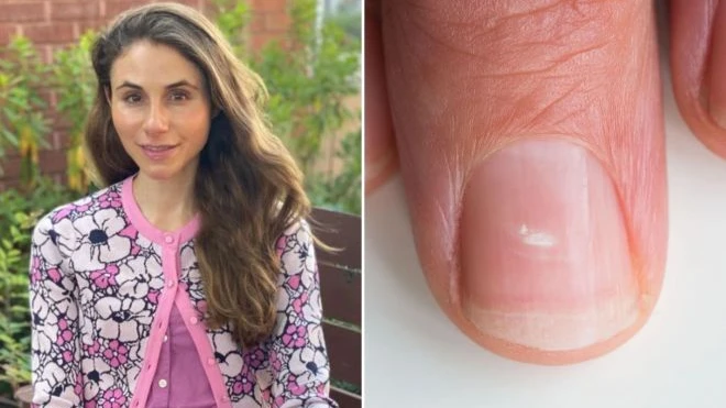  Пять зловещих и опасных заболевания следует искать в 9 признаках на ваших ногтях