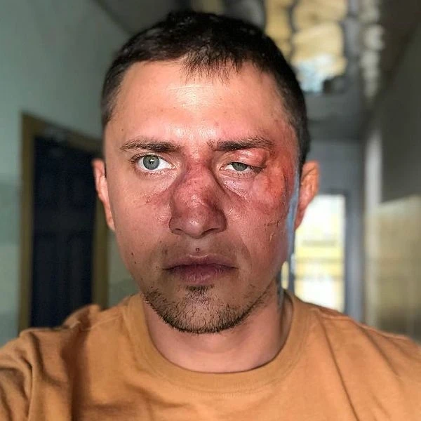 Как сейчас выглядит Павел Прилучный после операции?