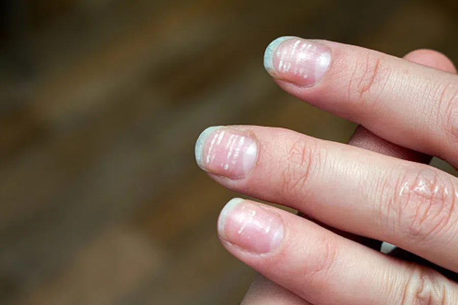 Белые ногти: что делает с организмом дефицит цинка?