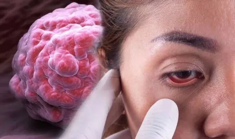 Хламидиоз: симптом широко распространенной ИППП может проявиться на вашем лице