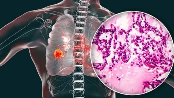 Рак легких не всегда вызывает симптомы на ранних стадиях. Фото: Еxpress.co.uk