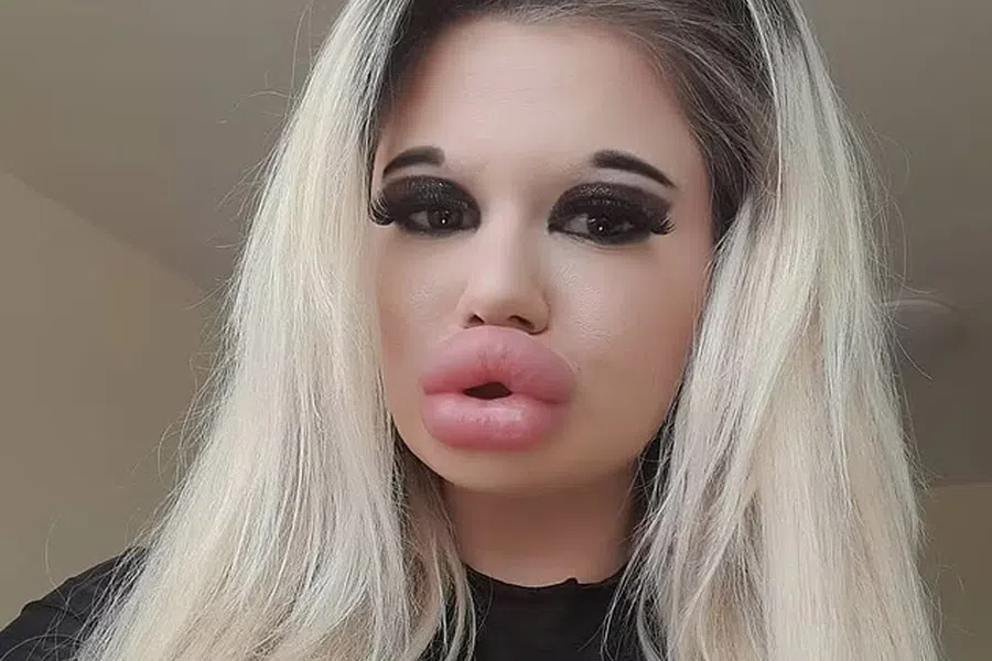 26 уколов в губы и это не предел: женщина с самыми большими губами в мире хочет выглядеть как кукла Братц