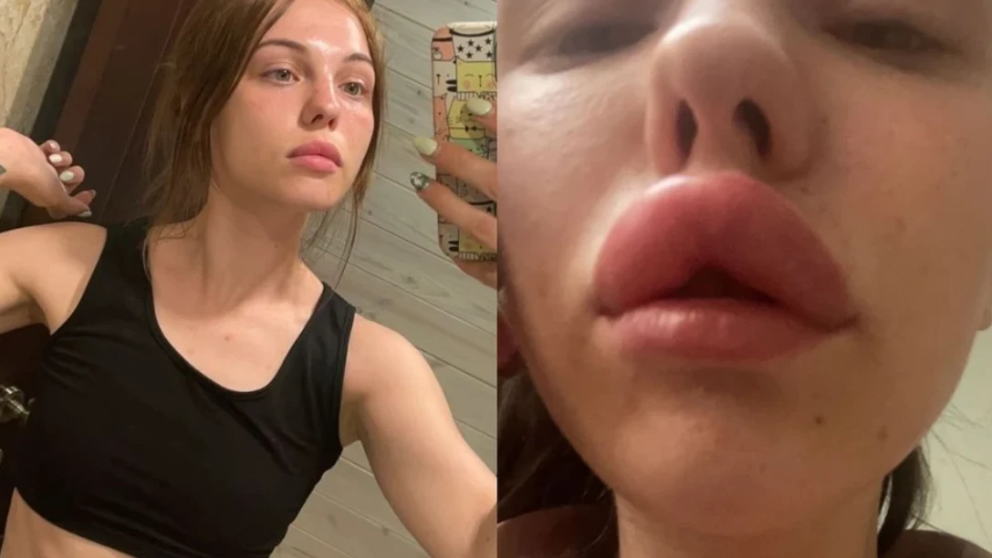 «Слюни текут, говорю с дефектом»: У жительницы Новосибирска парализовало часть лица после вмешательства косметолога в губы