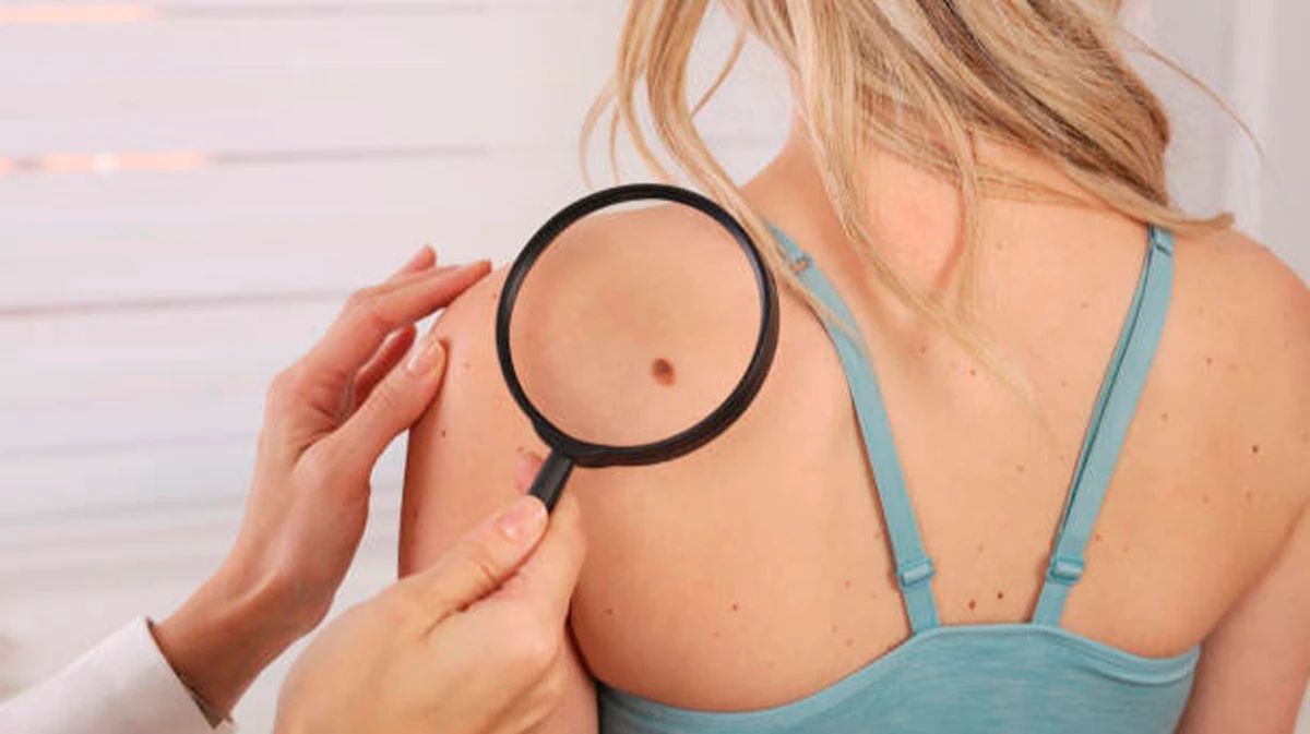 Как выглядит рак кожи? 10 признаков онкологии кожи, профилактика и лечение 