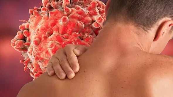 Симптомы рака можно пощупать на теле: шишки растут на шее, подмышках, животе, паху, груди, груди или яичках
