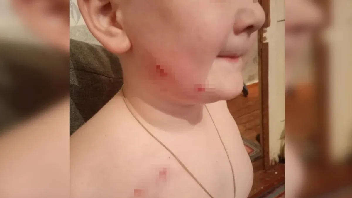 Он громко плакал и звал на помощь: Под Новосибирском бродячая собака вцепилась в лицо 5-летнего ребенка 