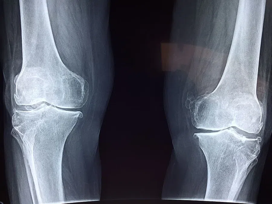 рентген, колени
